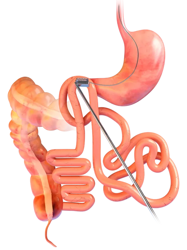 Illustration of the digestive system, with the two small magnets meeting between two sections of the gut. Anatomical artwork courtesy of GT Metabolic