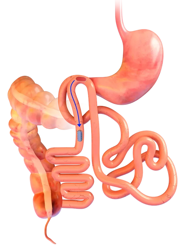 Illustration of the magnets, still joined together, moving on through the intestine after the new connection has formed. Anatomical artwork courtesy of GT Metabolic
