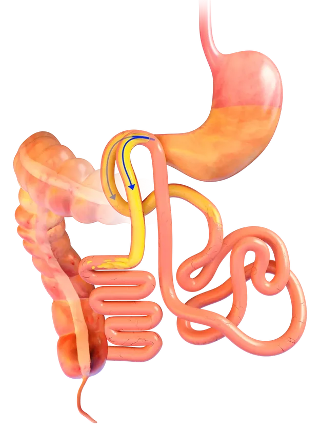 Illustration of food, shown in yellow, taking the shorter route through the new connection. Anatomical artwork courtesy of GT Metabolic